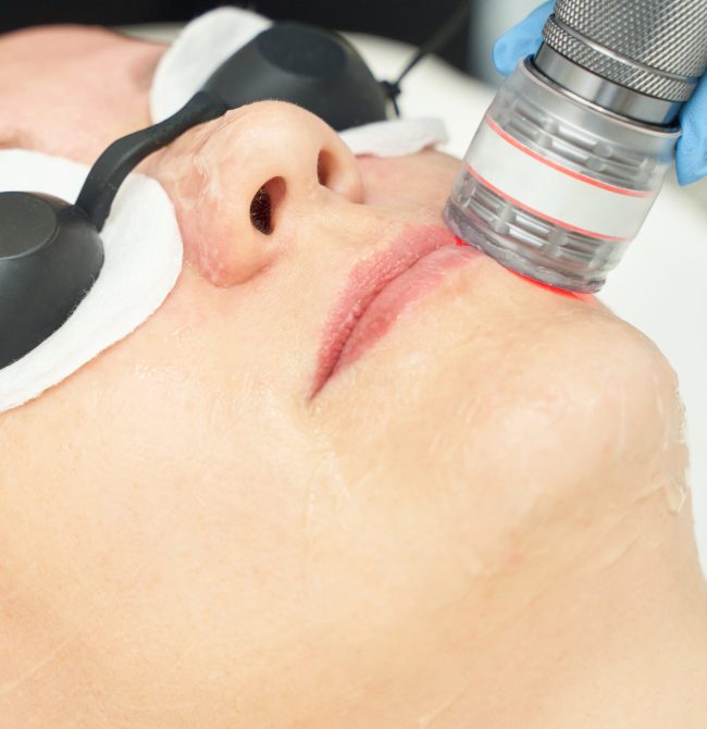 Close-up of laser skin treatment on adult female during facial procedure for skin renewal and rejuvenation.